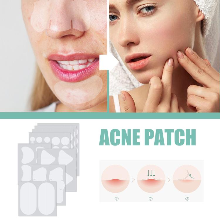 Breathable hydrocolloid acne patches placed on cheeks and lip area on a woman’s face