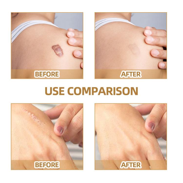 Waterproof skin scar acne mark covering patch applied over a small dark spot