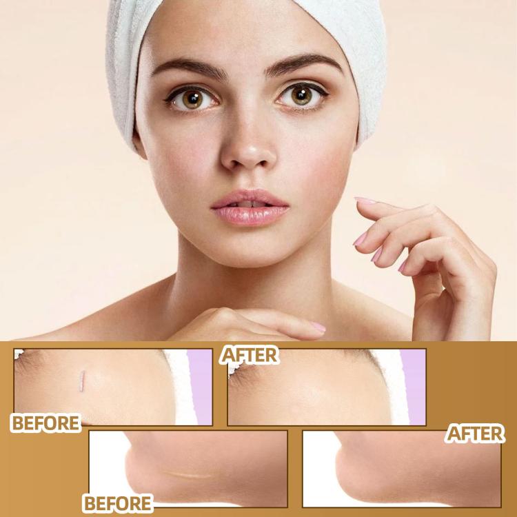 Waterproof skin scar acne mark covering patch on face area, before and after