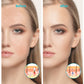 Before-and-after style view featuring the LED acne light device treatment