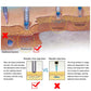 Needle-free injection infographic comparing dermal delivery versus needle injection