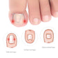 Toe nail orthotic hooks with fit type diagrams