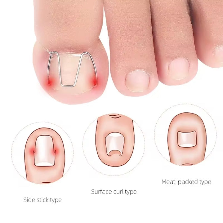 Toe nail orthotic hooks with fit type diagrams