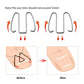 U-shaped toe nail orthotic hooks with before-and-after diagram