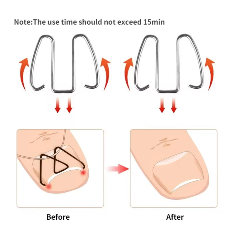 U-shaped toe nail orthotic hooks with before-and-after diagram