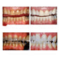 Teeth whitening results photo set showing multiple close-up tooth views